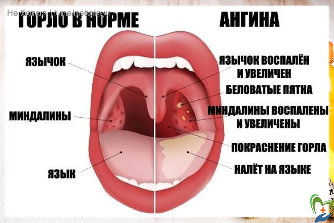 аденоиды фото во рту