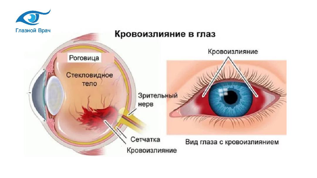 Есть видимые повреждения. Кератит, конъюнктивит, увеит). Птеригиум конъюнктивы пингвекула. Кровоизлияние в стекловидное тело глаза. Кровоизлияние в роговицу глаза.