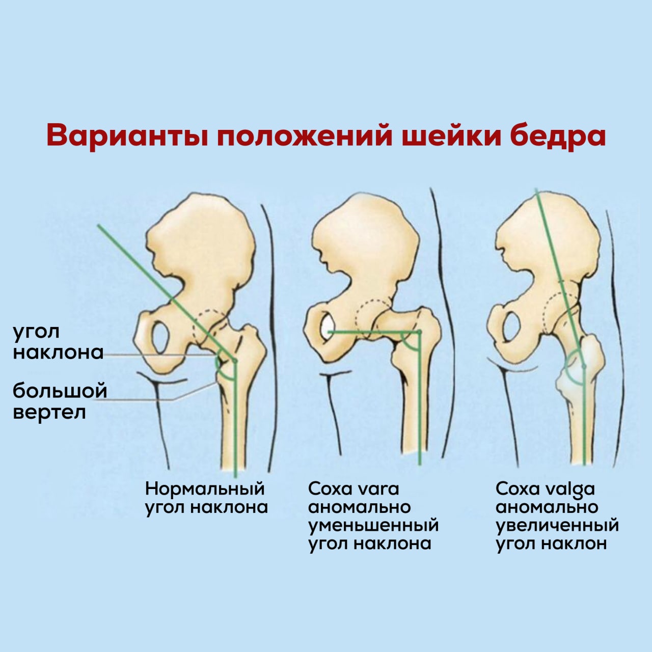 Coxa vara тазобедренного сустава. Coxa Valga электростимуляция.