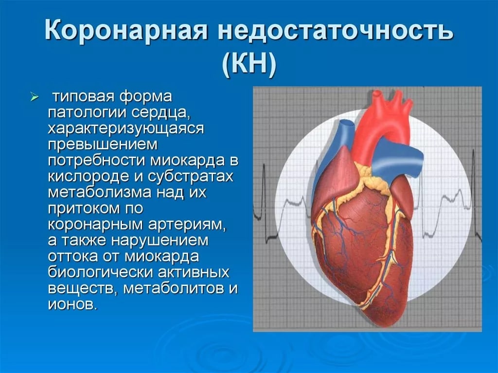 Нарушение коронарного кровообращения боковой стенки