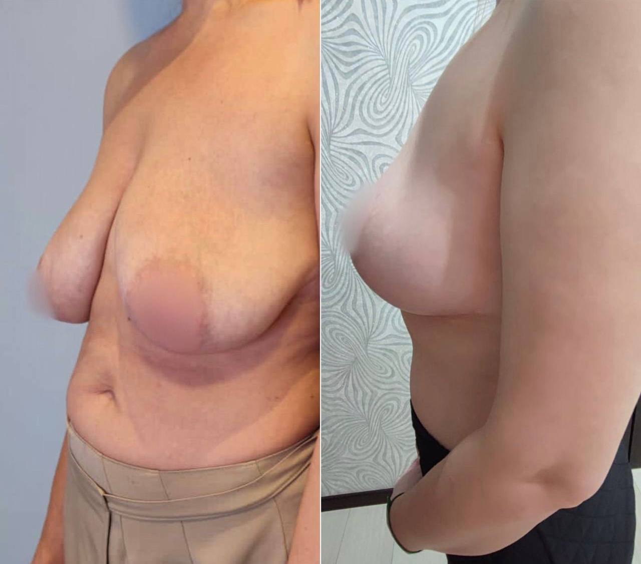 маммопластика одна грудь ниже другой фото 56