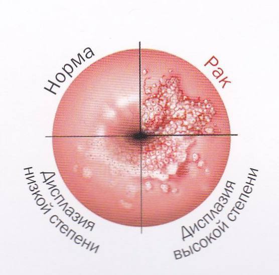 Кольпоскопическая картина 1 степени