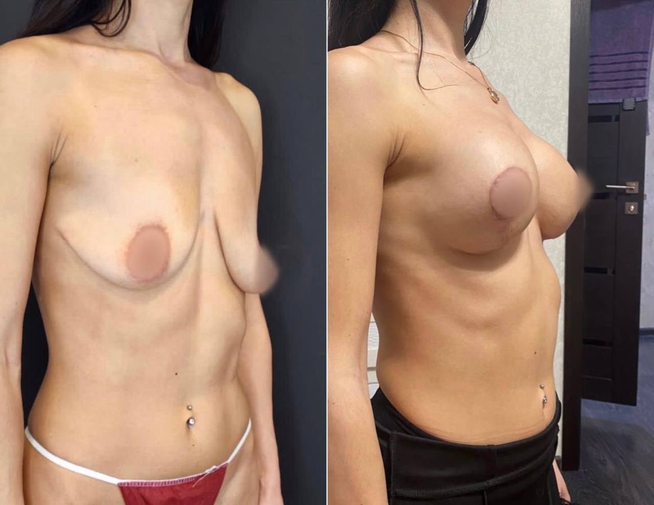 удаление импланта груди у женщин фото 75